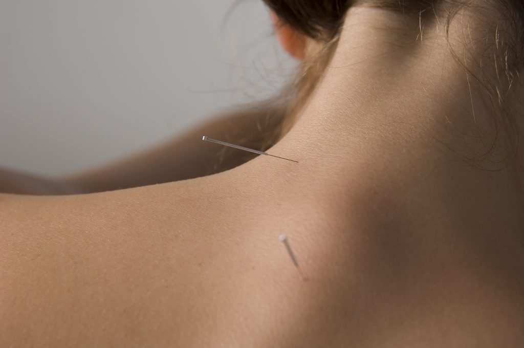 acupuncture in Marbella Costa del Sol